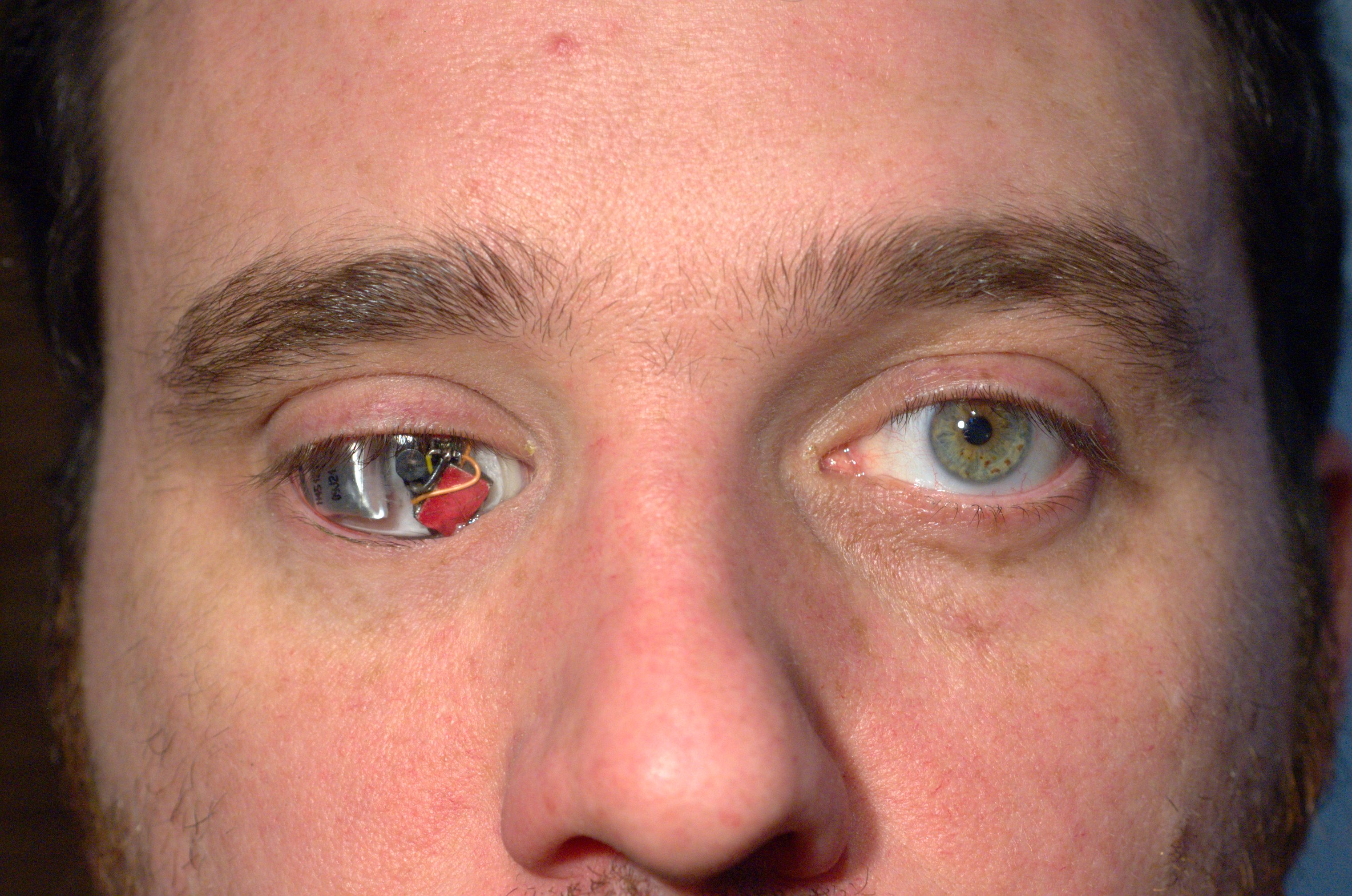 Der Mann mit der Augenhöhlen-Cam: Auf dem Weg zum "Eyeborg"